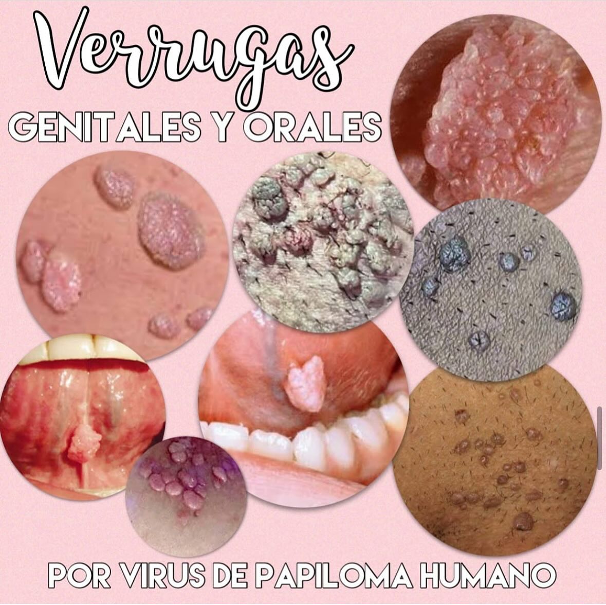 MedicFem - Las verrugas o condilomas es una de las...