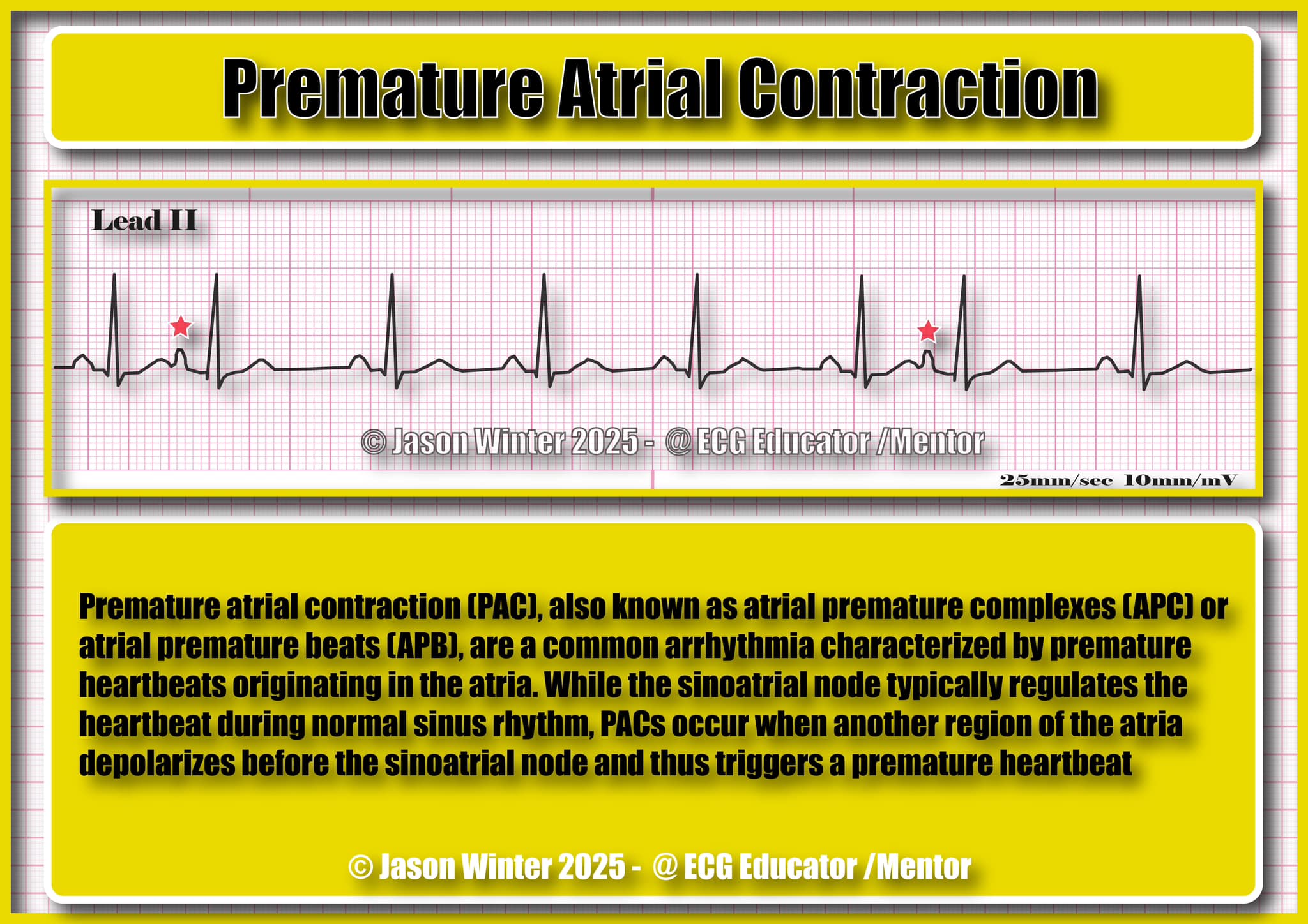 Premature Atrial Contraction Strip UNC MEDIA | Heart Rhythms