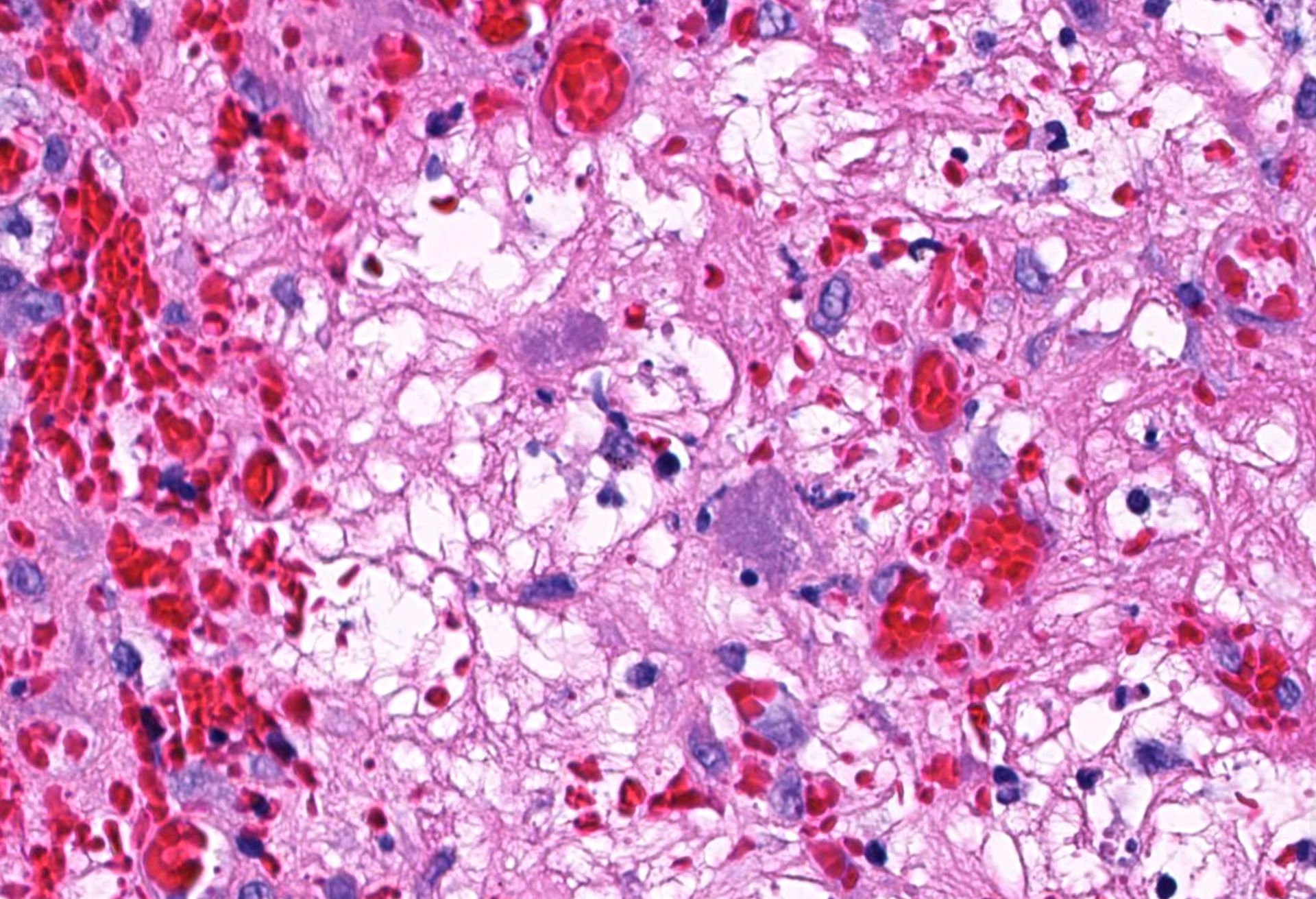 Jerad - Violaceous nodule on leg of elderly adult. Diagnosis? WSI ...
