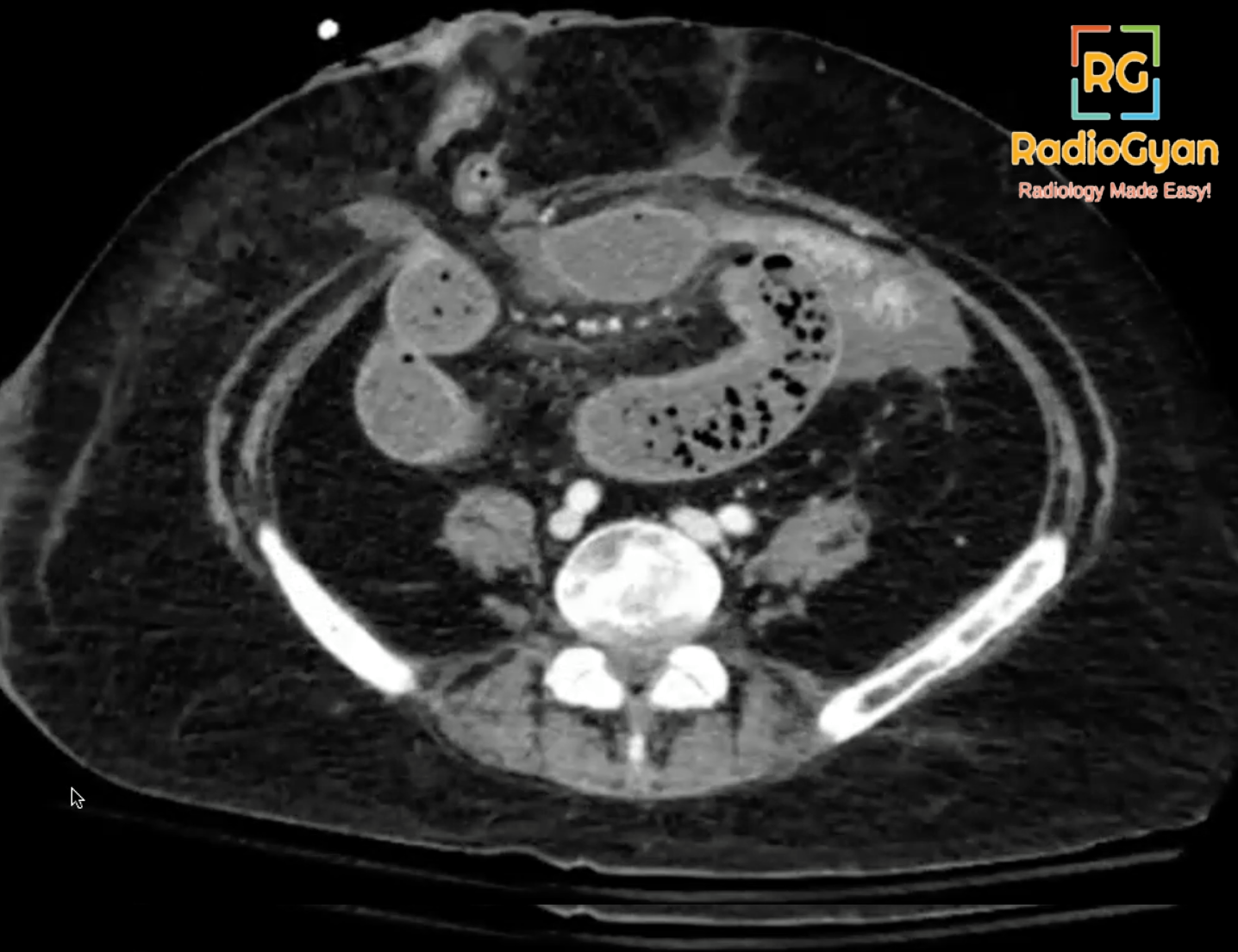 Name the sign and its... - RadioGyan - Radiology Made Easy