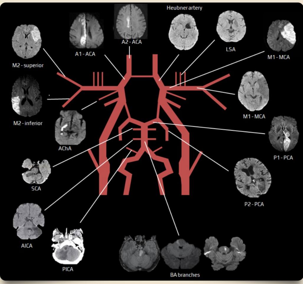Neurology - Cortical laminar necrosis (CLN) CLN is... | Facebook