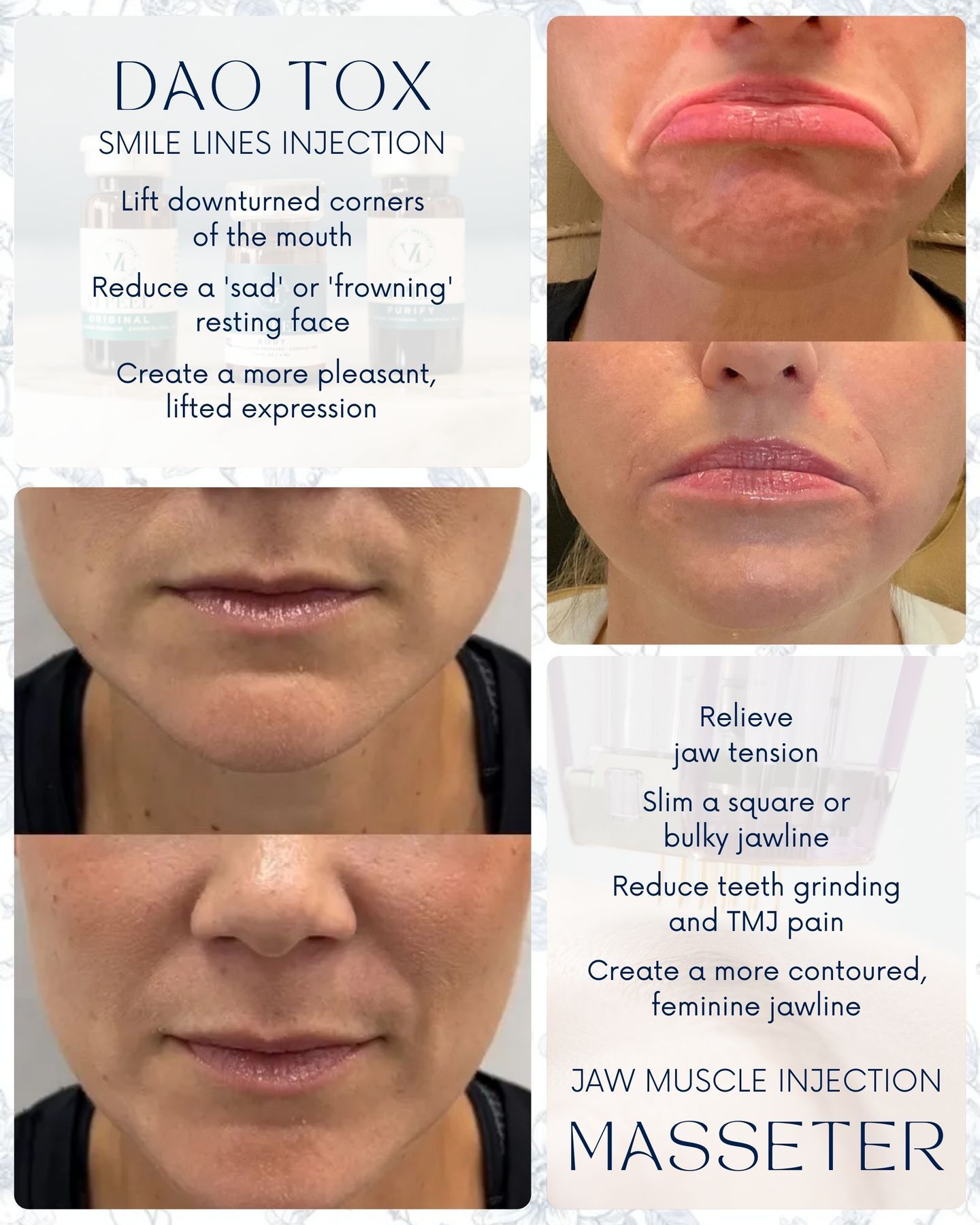 Blue - Masseter Tox vs DAO Tox... same product, totally different ...
