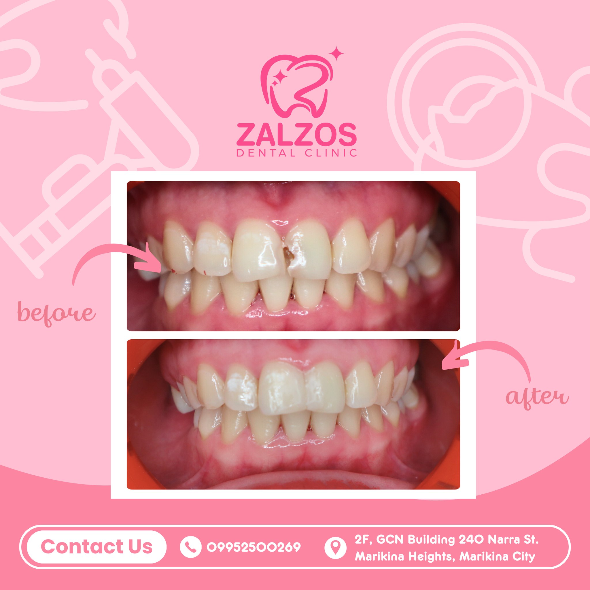 🦷 Tooth Restoration 🦷 ☎️ For... - Zalzos Dental Clinic | Facebook