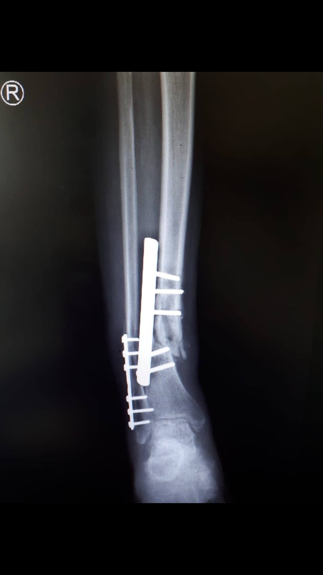 This patient has infected malunion distal tibia. The ideal treatment ...