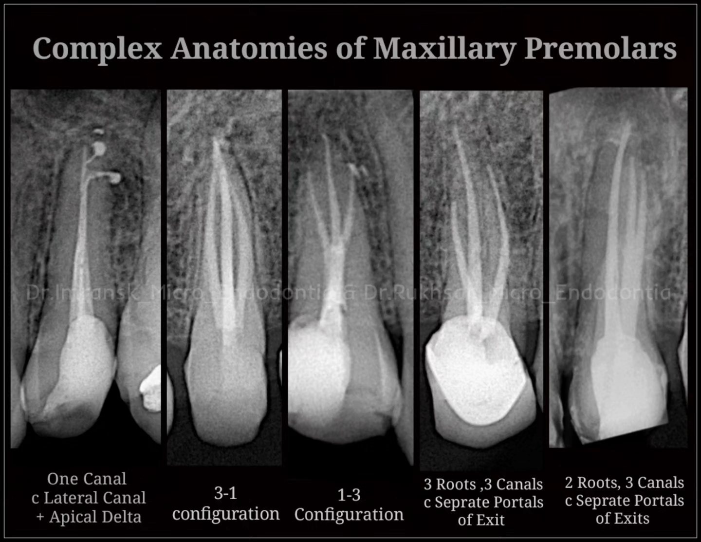 Dr.Imran - Rare Complexities of Maxillary Premolars, Anatomy is like # ...