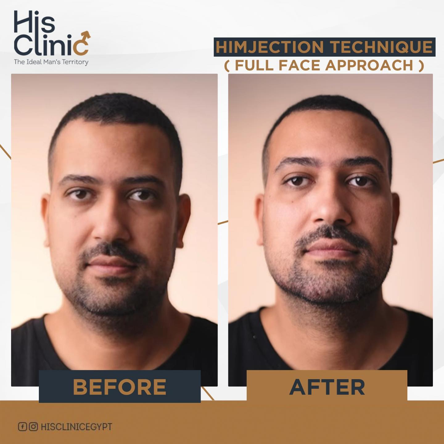 His Clinic - Watch the power of Himjection transformation... | Facebook