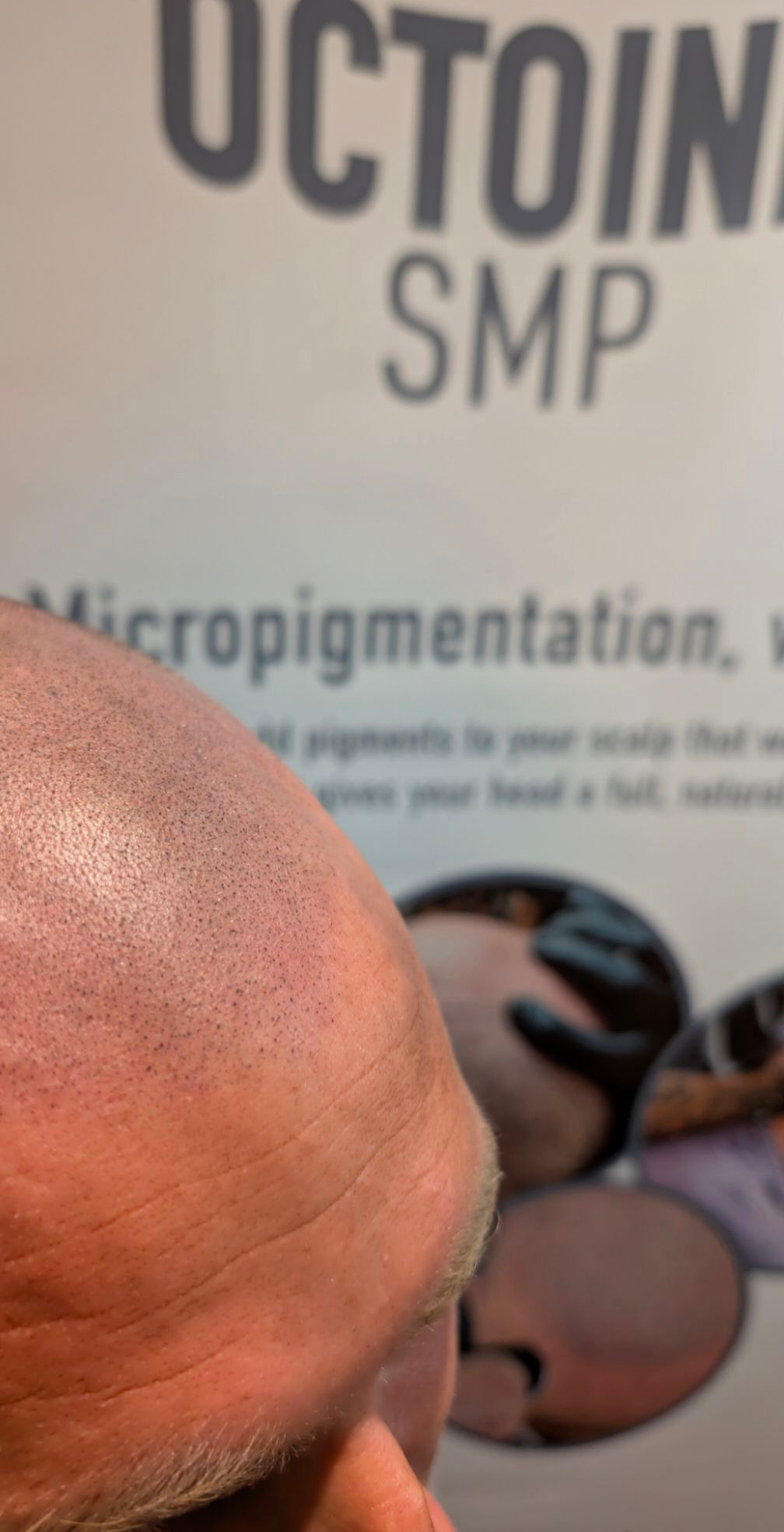 Octoink Scalp Micropigmentation