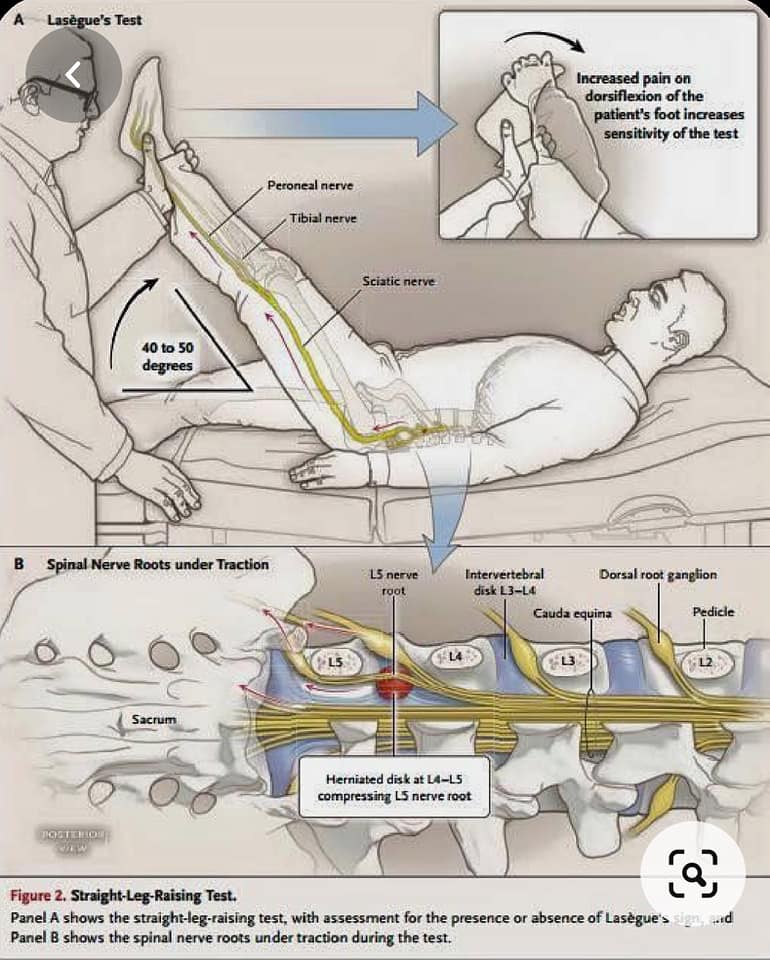 📌SLR test ทบทวนกันหน่อย ... - POM PT medical จำหน่ายเครื่องมือและ ...