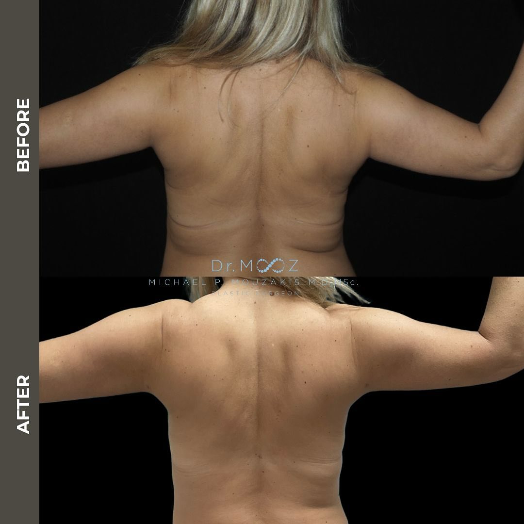 lipo c hockley Back can target fat on the upper back (around the shoulders), the mid back (targeting what we call 'bra fat') and the lower back (around the flanks and hips, which may Immune Support Supplements | Qty:60 Cats