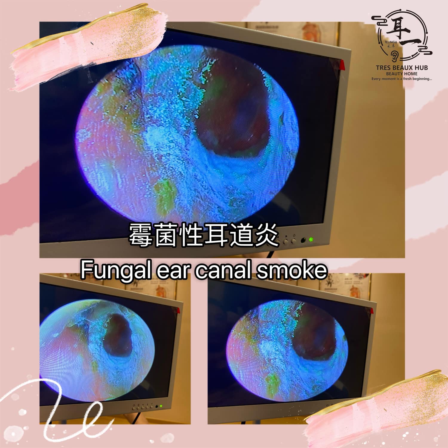 Linlin - Fungal otitis🍀👂 Popular science knowledge, what is fungal ...