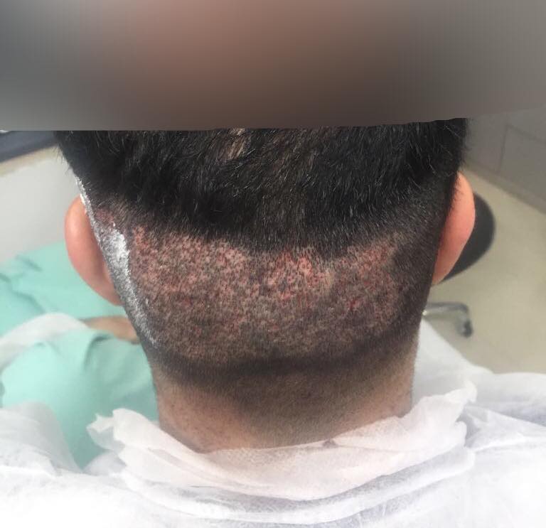 عو Faqieh Hair Transplant Center مركز الفقيه لزراعة الشعر Facebook