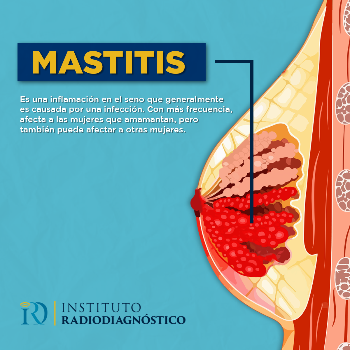 Instituto Radiodiagnóstico - La mastitis es una inflamación (hinchazón ...