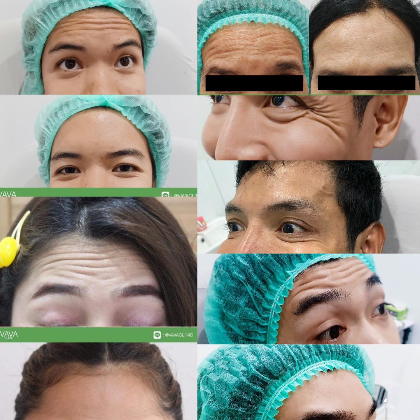 Botox Buffet ::... - VAVA clinic - วาวา คลินิก สุรินทร์ | Facebook