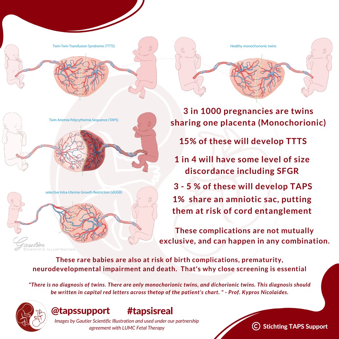 The TAPS - TTTS, TAPS, and SFGR are rare diseases that affect twins ...