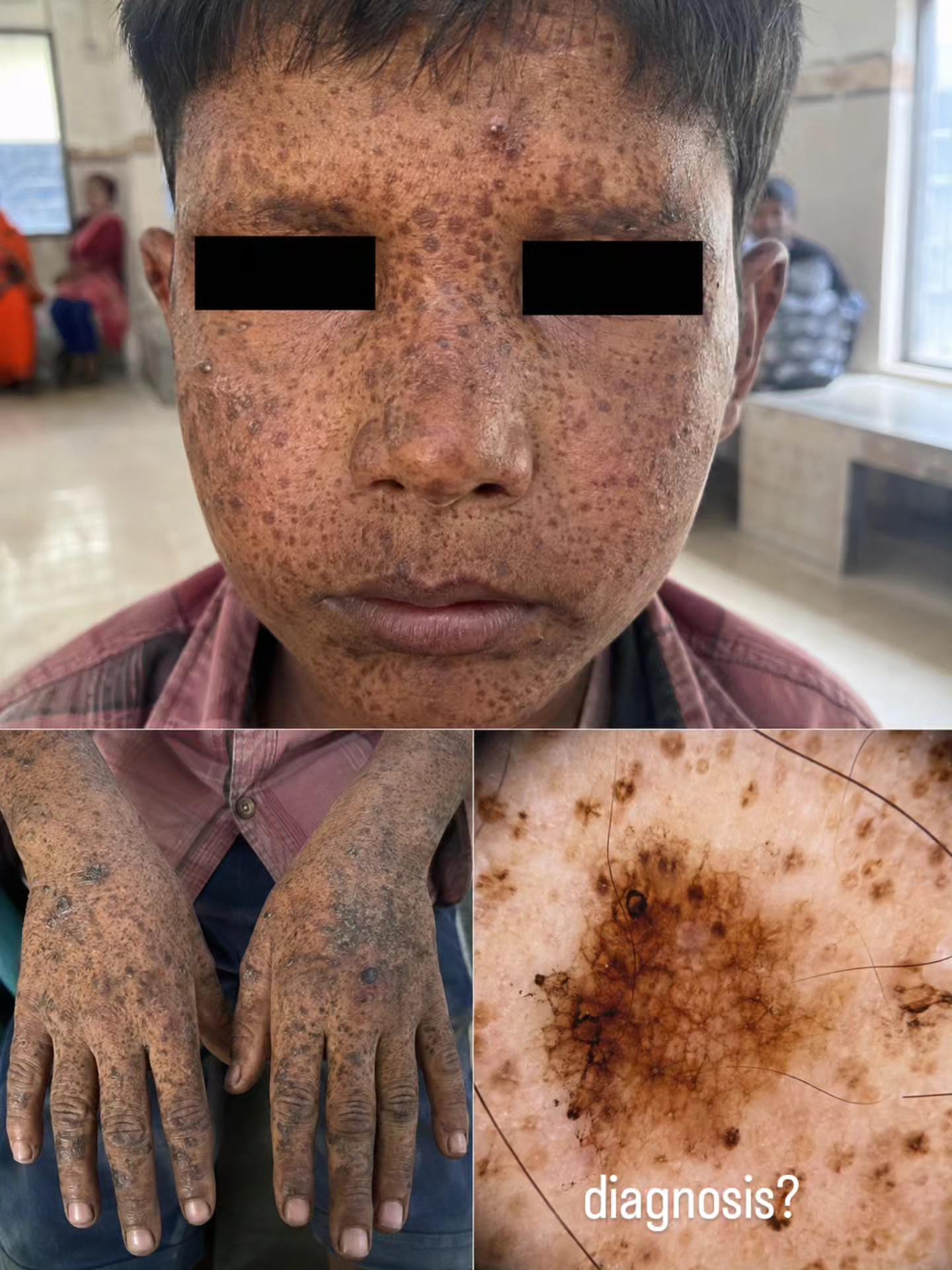 12. Hutchinson's melanotic freckle. Which of the following is not correct?a) Mostly occurs in the elderlyb) Mainly occurs in covered parts of the body c) Malignant d) Irregular bordere) Irregular colo