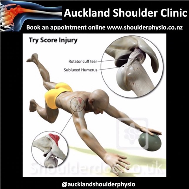 Auckland Shoulder Clinic - Rugby Shoulder Injuries The Rugby Try Score ...
