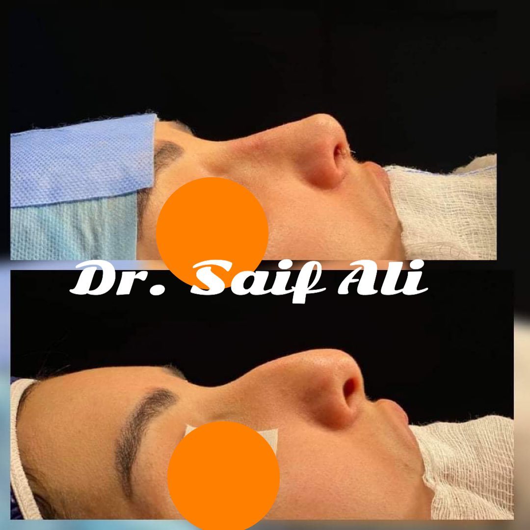 Dr. Saif Ali - Dr. Saif Ali Almahidi Rhinoplasty د. سيف... | Facebook
