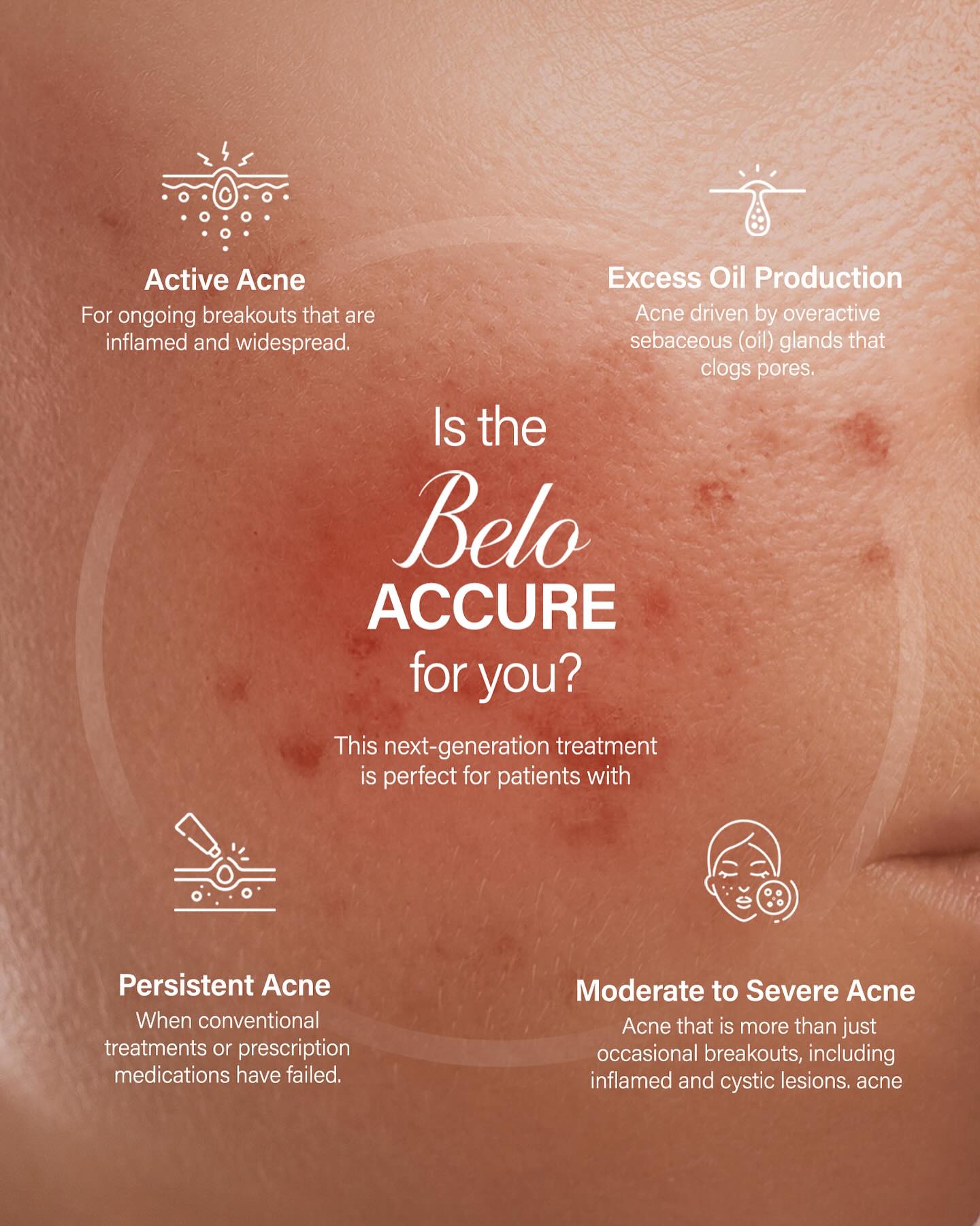 THE cure for acne is here 🔥 Introducing the #BeloAccure: The ultimate answer for breakouts that just won't quit 💯This groundbreaking laser reaches the precise depth where sebaceous (oil) glands are located—