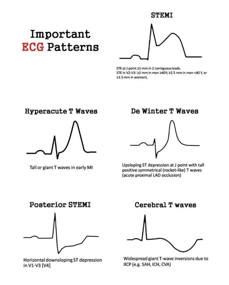 Caduceus EM & Critical Care FOAM | 🩺Important ECG Patterns | Facebook
