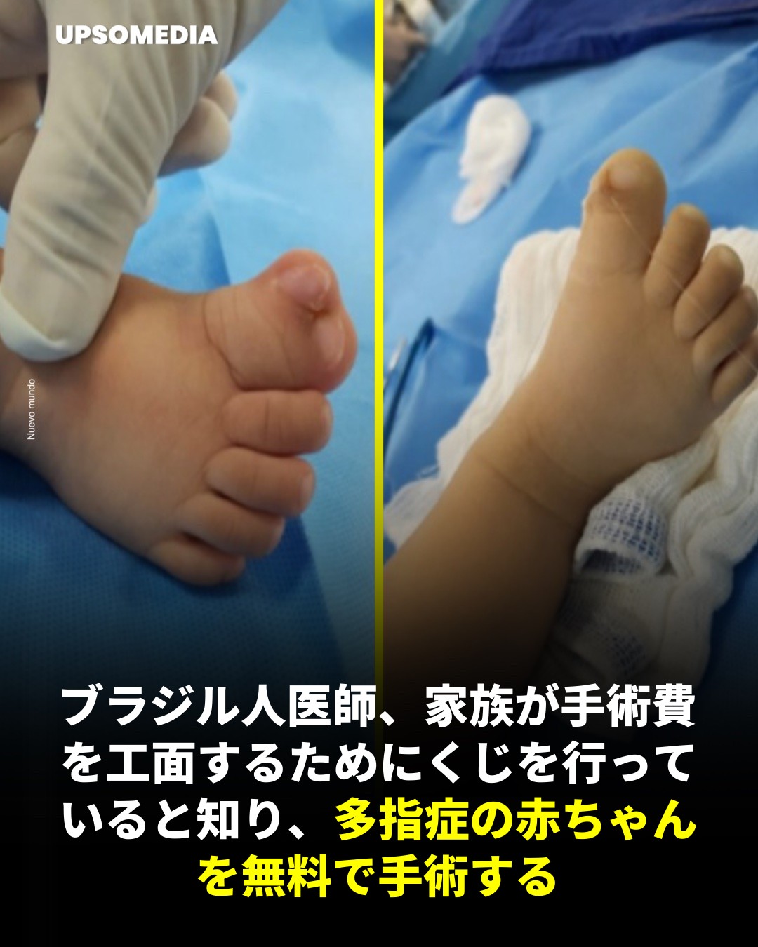 ポジティブ - ブラジルのポンタ・グロッサ市の整形外科医エドゥアルド・マットスという医師が、多指症という余分な指がある状態で生まれた赤ちゃんを ...
