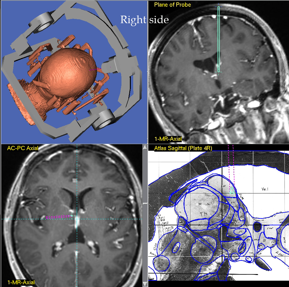 Advances in Epilepsy Surgery