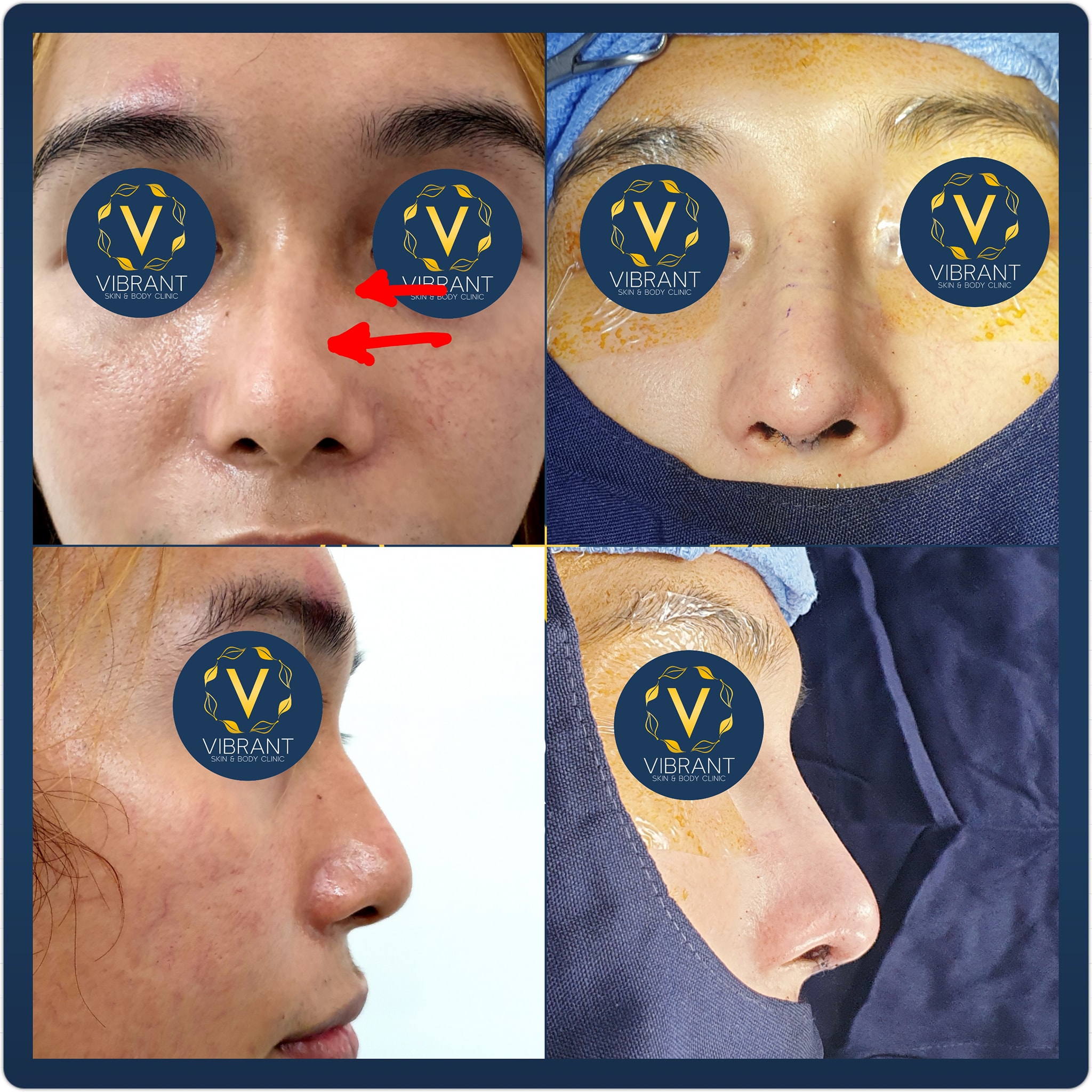 Deviated Nasal... - Vibrant Skin & Body Clinic by Dr. Ordillo | Facebook