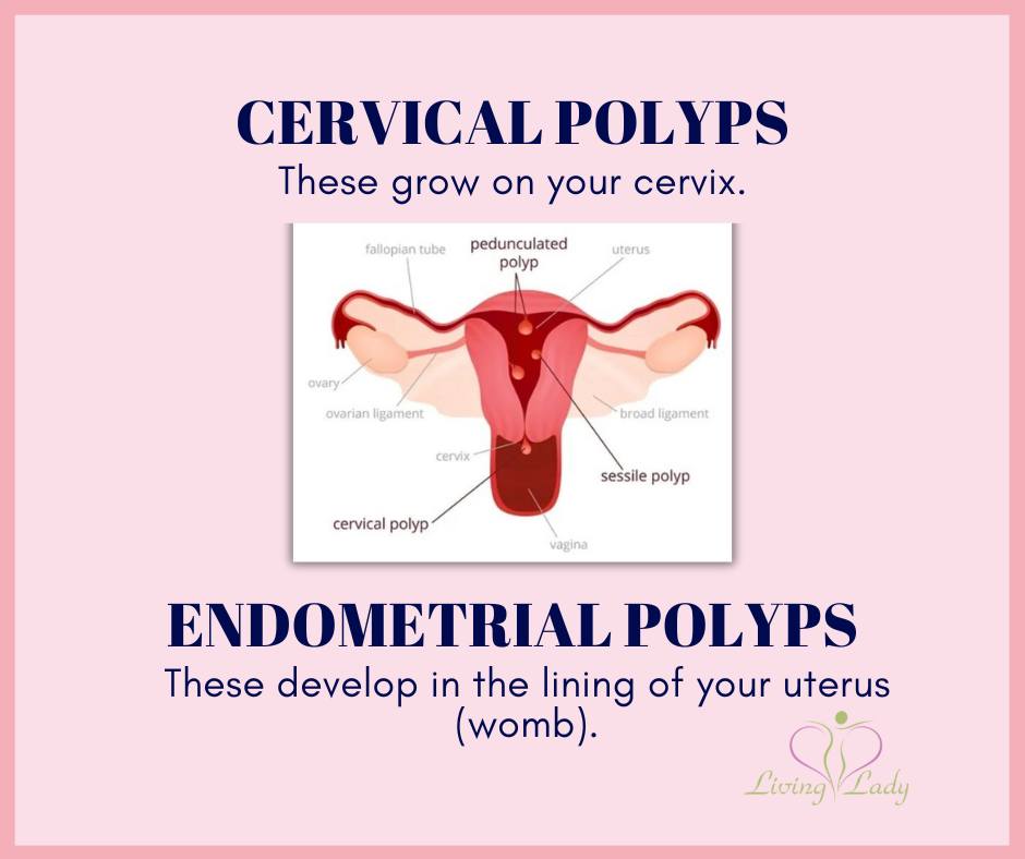 A polyp is a growth in your... - Living Lady - Dr. Roshni