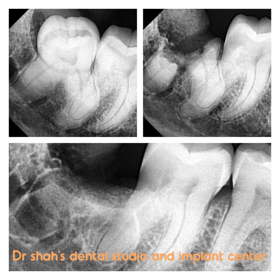 Dr. Shah's Dental Studio & Implant Center - Wisdom tooth with Dancing ...