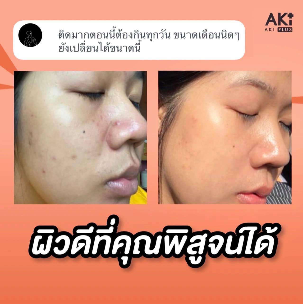 Akiplus - 🍒Aki Plus 🍒 ผลิตภัณฑ์อาหารเสริมเพื่อผิวสุขภาพดี... | Facebook