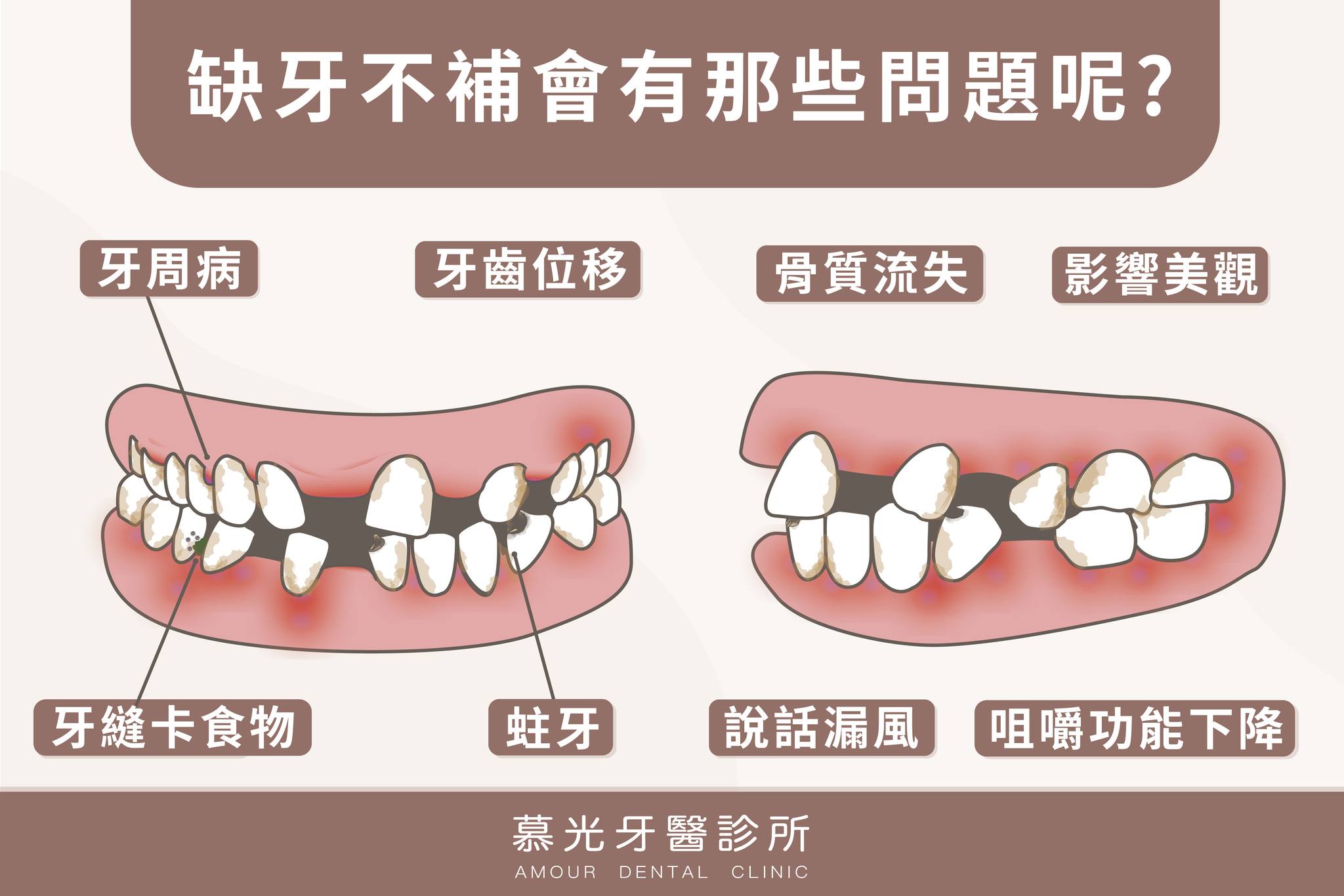 慕光牙醫診所 - 大家都知道缺牙不補，可能會造成牙齒傾倒，但缺牙的危害比你想像得多更多喔，今天讓慕光來告訴你吧～...