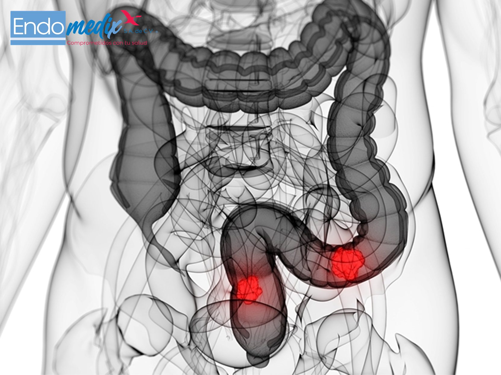 Endomedix - La Sigmoidoscopia es un procedimiento empleado para ver el ...