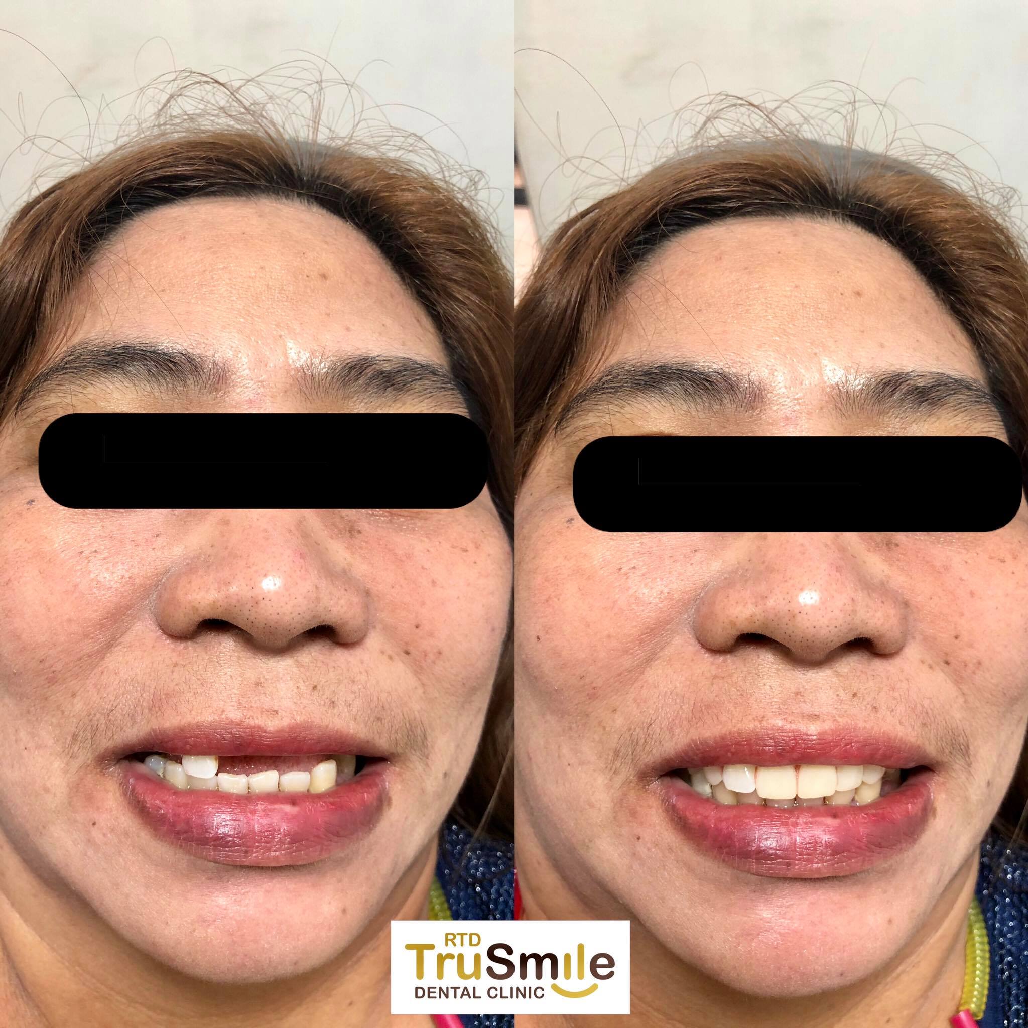 RTD TruSmile Dental Clinic - ️ Upper Removable Partial Denture 📌 A ...
