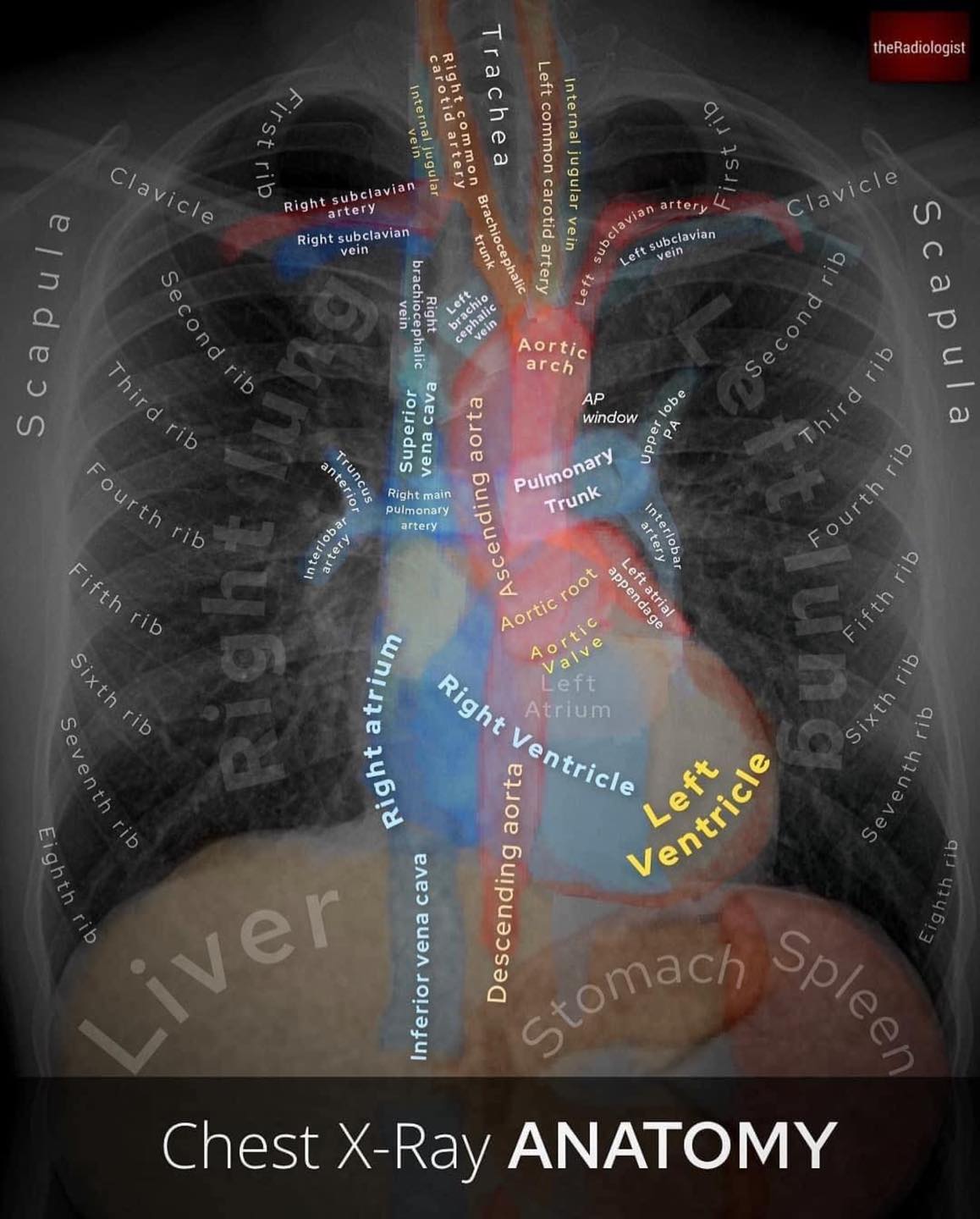 PhysioOsteoBook - Heart: Analysis by The Radiologist “Chest X-Ray fused ...