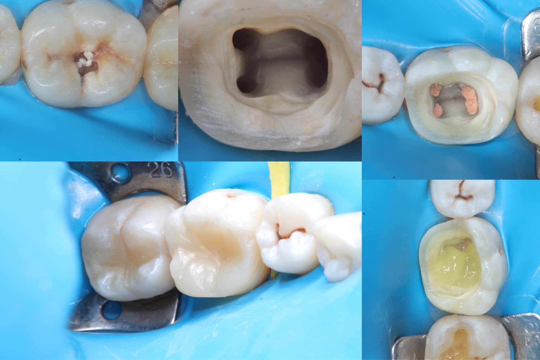 Style Italiano Endodontics | RCT for LR6 Direct composite for LR7 Some ...