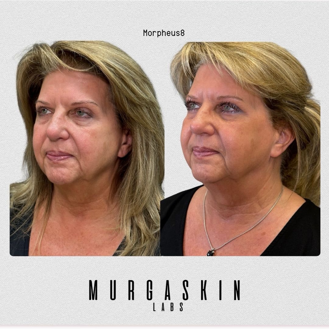 MurgaSkin - #retatrutide before and after This peptide is so good at leaning the body. It's insane… #reta #peptides #orlando #doctor