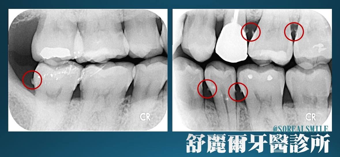 铁山角冲牙器a649af030 洁牙器深层自动蓝光牙结石日本清洁牙齿神器清洗器洗牙器通用电动 价格图片品牌报价 苏宁易购玫佳电器专营店