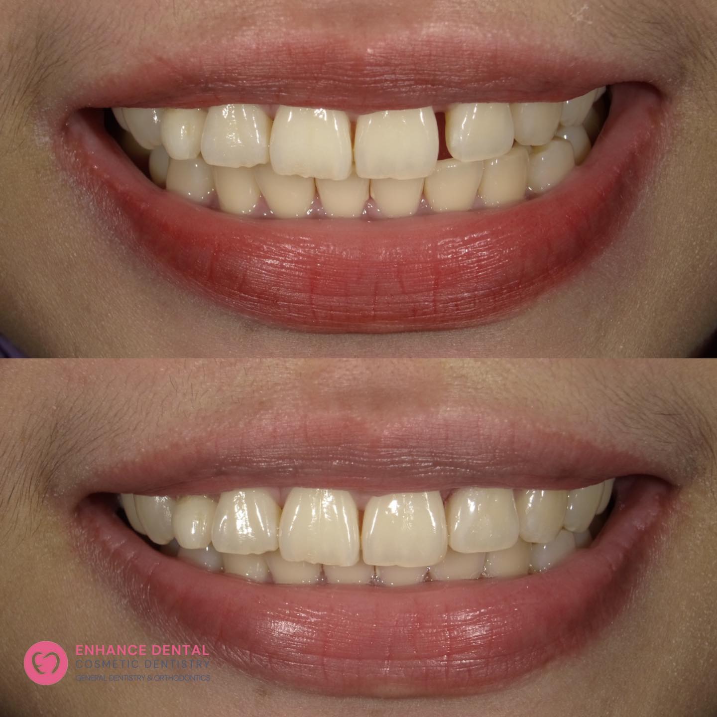 Enhance - Have spaces in between your teeth? Have them fixed via ...