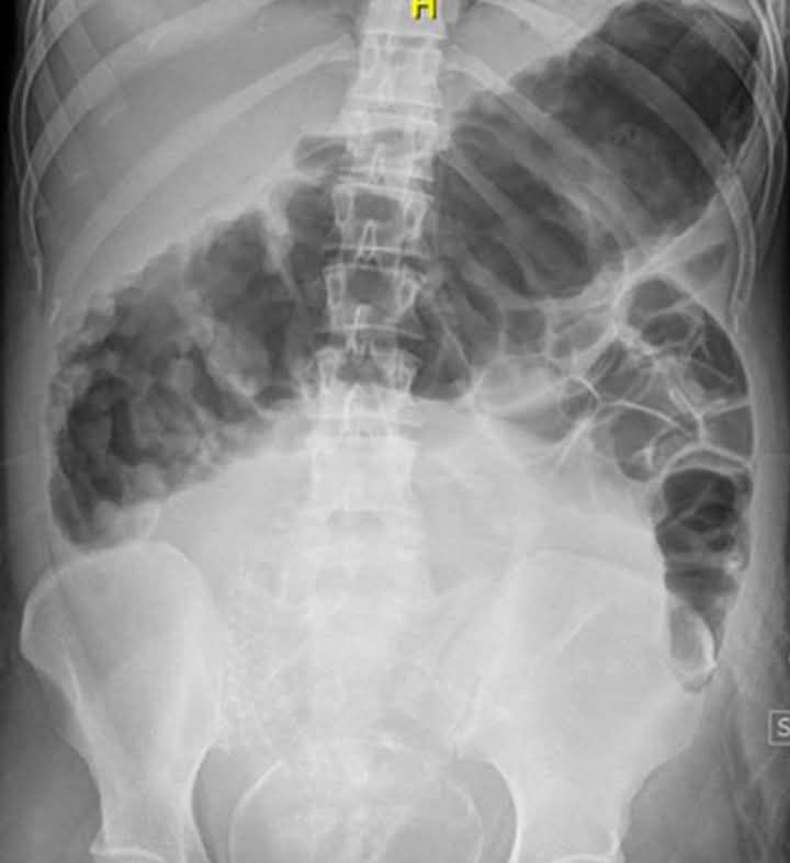 Normal Abdominal Xray Large Bowel Gas Image 363x442