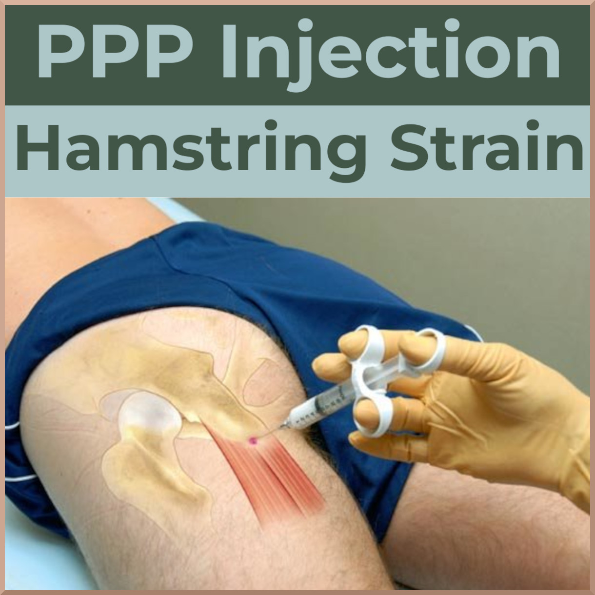 bpc 157 for hamstring tear PRP injections torn hamstring? Buttocks Ventrogluteal Intramuscular Injection US- Size:BIOMAX PRO GRANDE