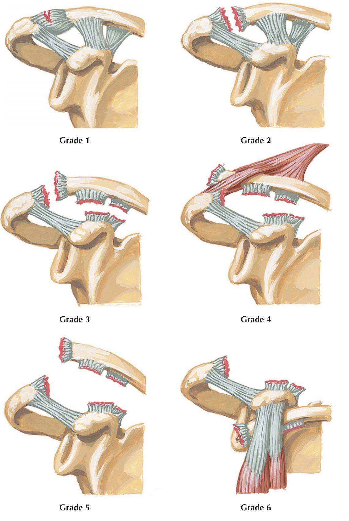 Dr. - Rockwood Classification of AC joint injury Grade 1: Sprain of AC ...