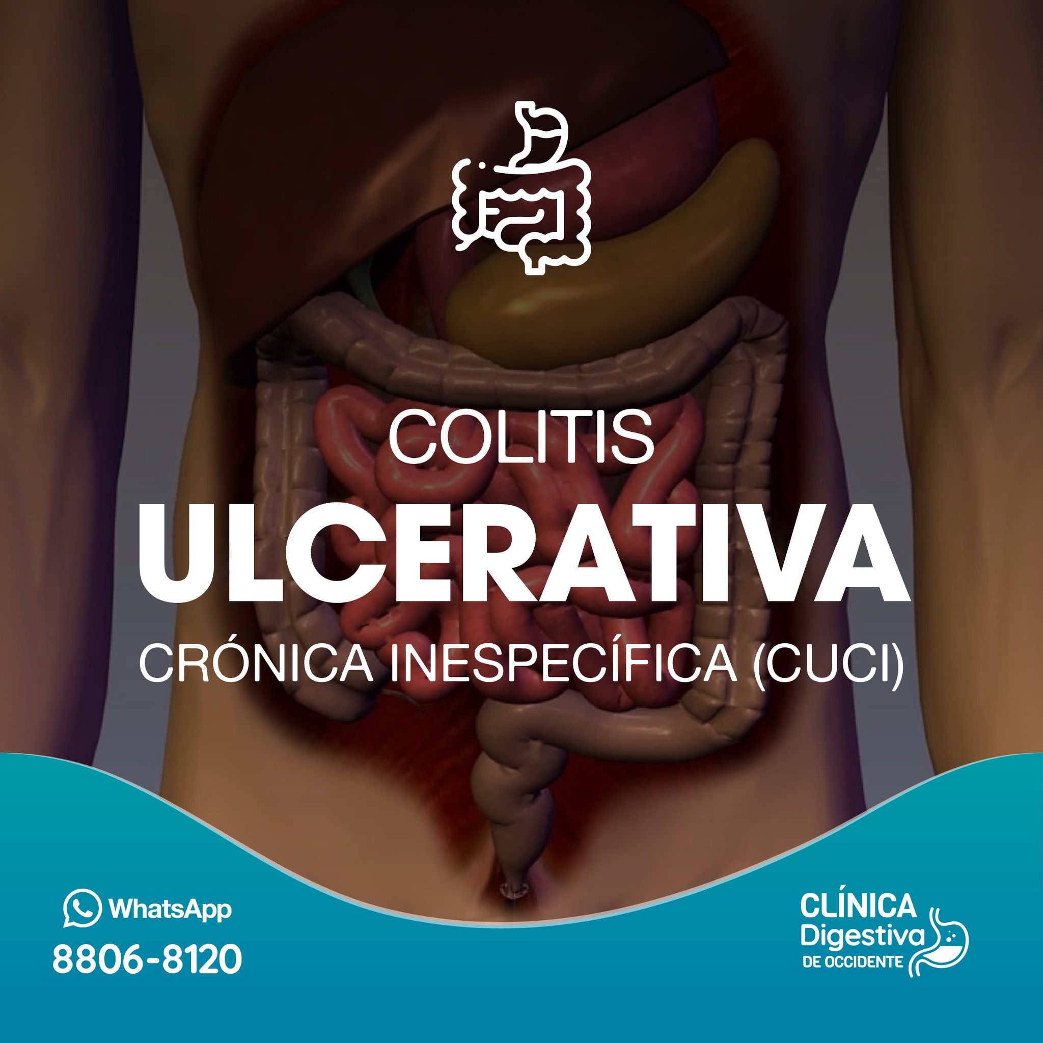 Clínica - 🔍 ¿Qué es la colitis ulcerativa crónica inespecífica? La ...