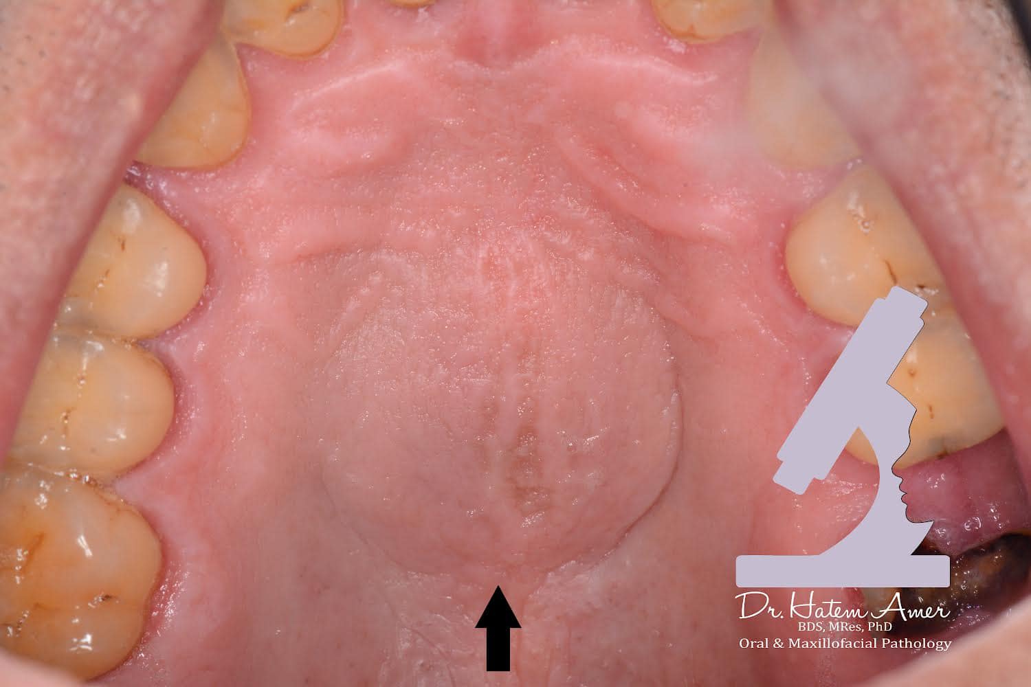 True median palatine cysts are EXTREMELY RARE.. this is the first one I ...