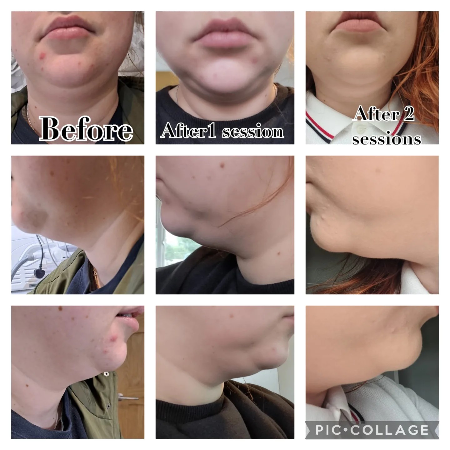 fat dissolving injections lemon bottle before and after Dissolver - STOMACH - & 4 Weeks Later W O W  These