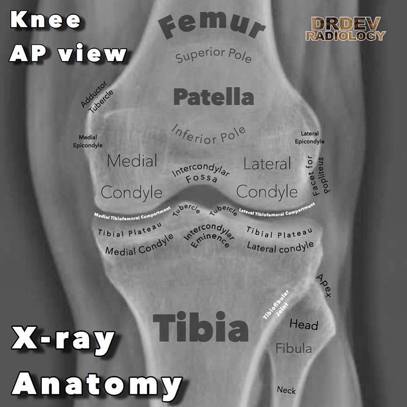 Devpriyo Pal - Anatomy of the Knee X-ray AP projection. ⁣⁣ It’s ...