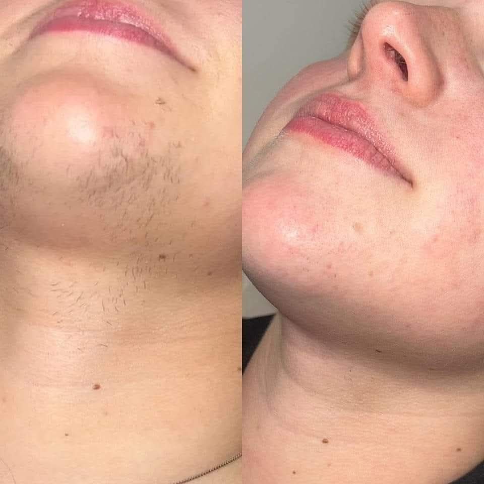 Top - Say Goodbye to Unwanted Hair with SHR Permanent Hair Removal ...