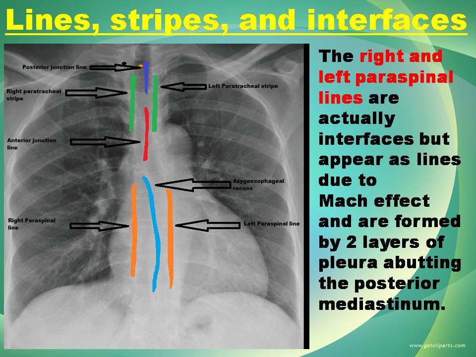 LINES, STRIPES AND INTERFACES... - Radiology Classroom | Facebook