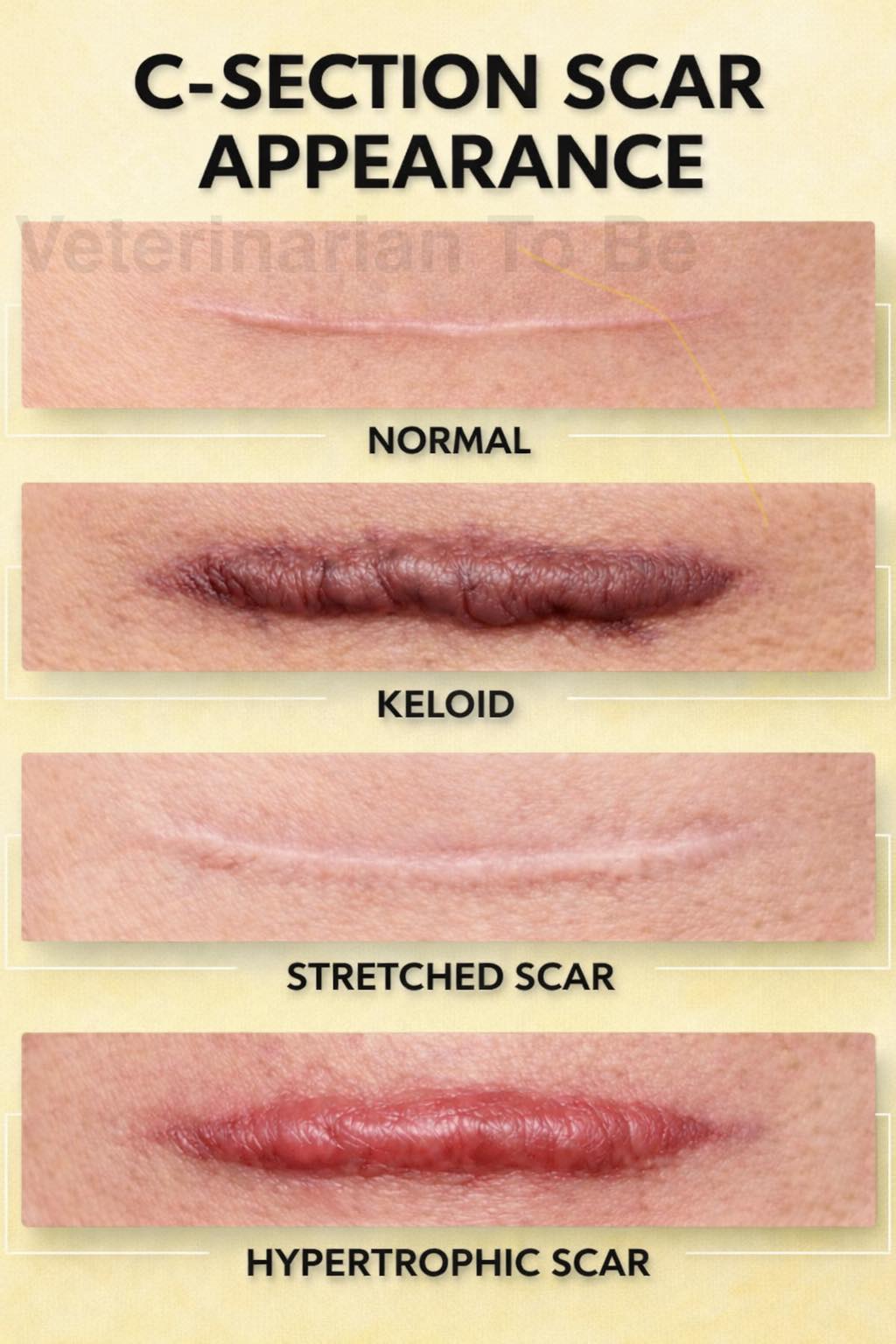 c section lip Different appearances of C-section (cesarean) surgical scars during healing: 1. Normal Scar • Flat, thin, pale line • Typical healthy healing • Usually fades over time 2. Keloid • Thick, raised scar ghk-cu fda approval status pore tightening Strength:500mcg