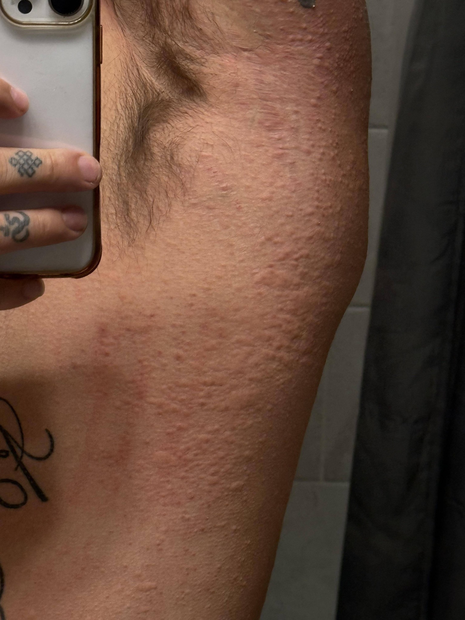 cjc 1295 ipamorelin itchy skin Allergic reactions to GHRP and CJC? Select:W How to Implement Effective Sydney