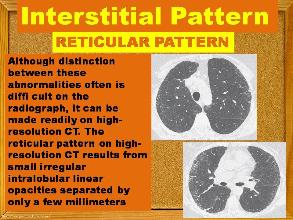 RETICULAR PATTERN IN CHEST - Radiology Classroom | Facebook