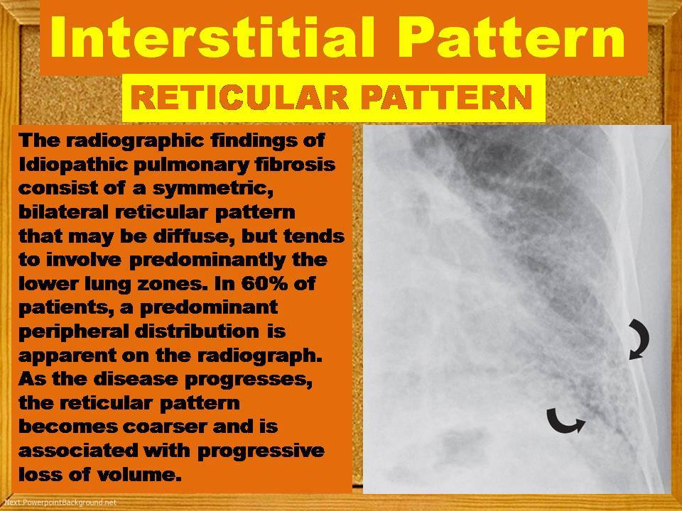 RETICULAR PATTERN IN CHEST - Radiology Classroom | Facebook
